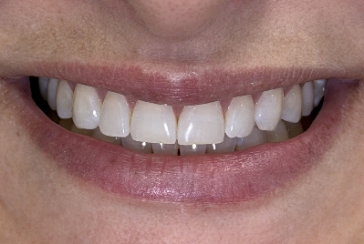 Sorriso depois do clareamento