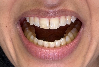 Sorriso sem a placa oclusal