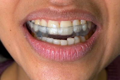 Sorriso com a placa oclusal em uso
