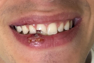 Sorriso antes da reabilitação com resina