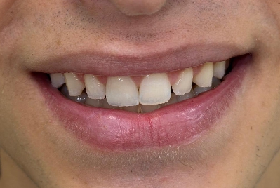 Sorriso depois da reabilitação com resina