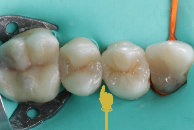 Dente depois da restauração
